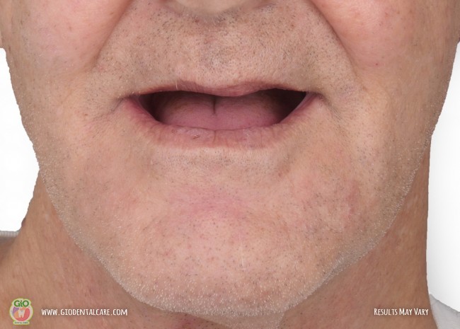 gio-dental-implants-1